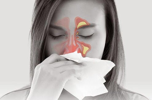 alerjik rinit nedir